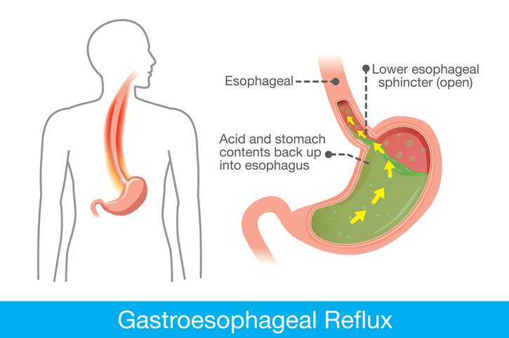 Cause of gastroesophageal reflux disease in human stomach