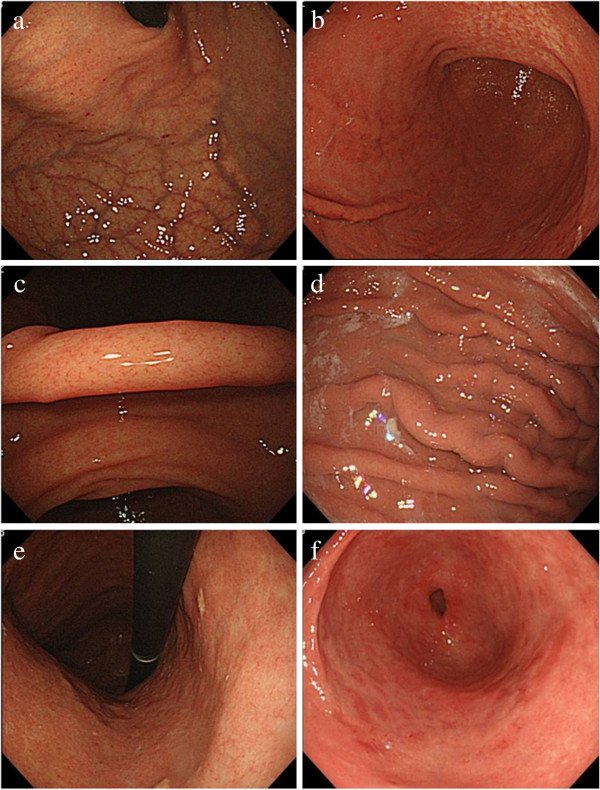 Different sites of the stomach showing H. pylori infection ...