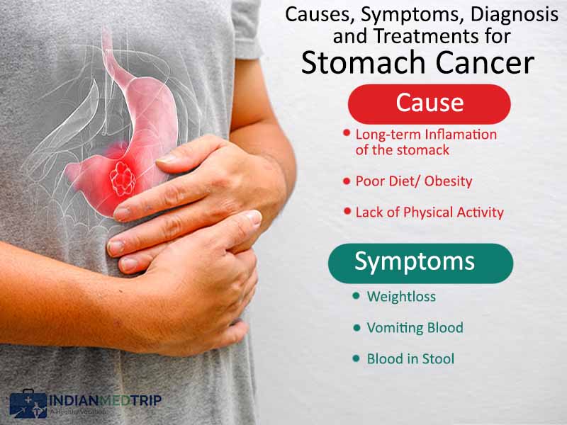 Sintomas De Cancer De Estomago