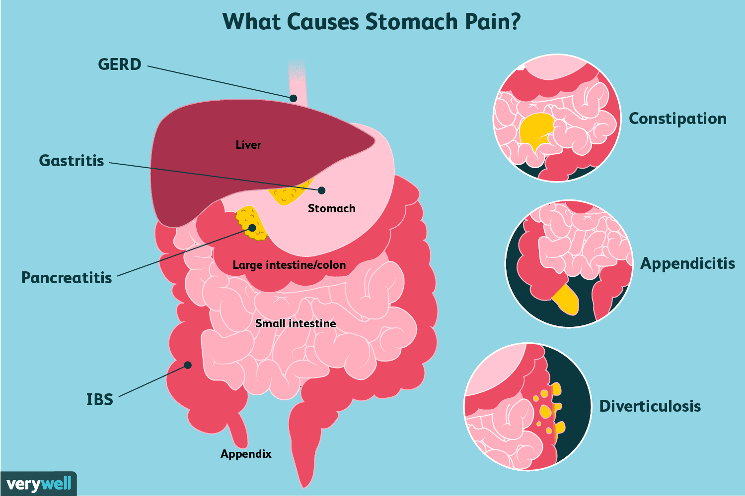 Stomach Pain: Causes, Treatment, and When to See a Doctor