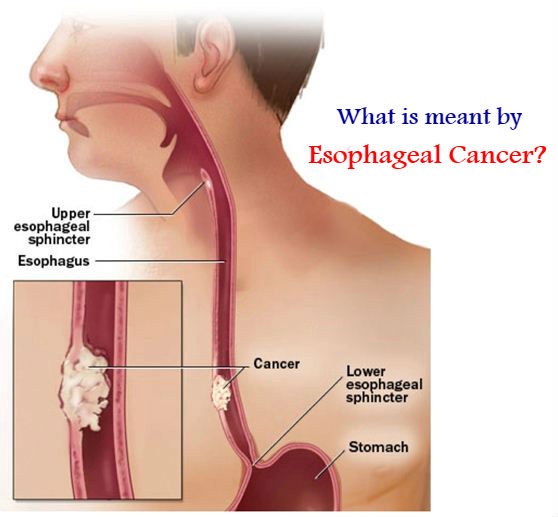 What Is Meant By Esophageal Cancer?