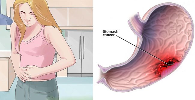 A SILENT KILLER: Stomach cancer â Most Common Yet ...