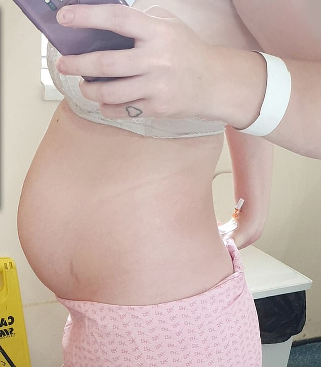 Bloated mother, 25, mistaken for being pregnant due to ...