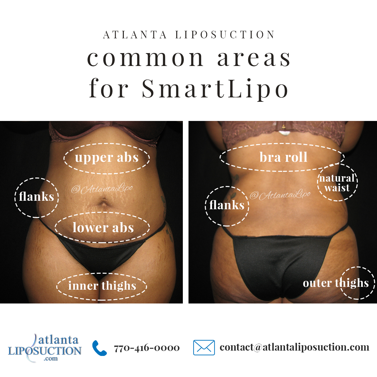 Common areas for SmartLipo laser liposuction. Atlanta ...