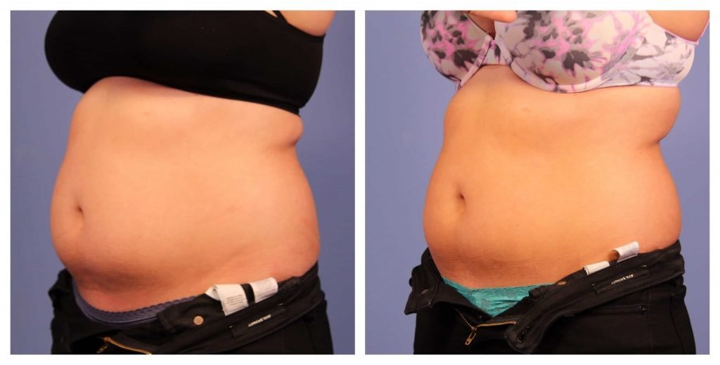 How Much Coolsculpting Stomach Cost - StomachGuide.net