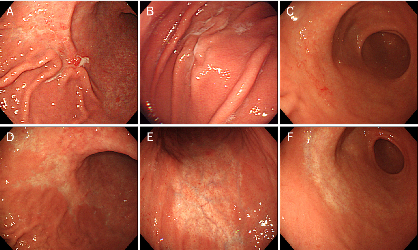 Figure 5 from [Diagnosis and treatment of gastric MALT ...