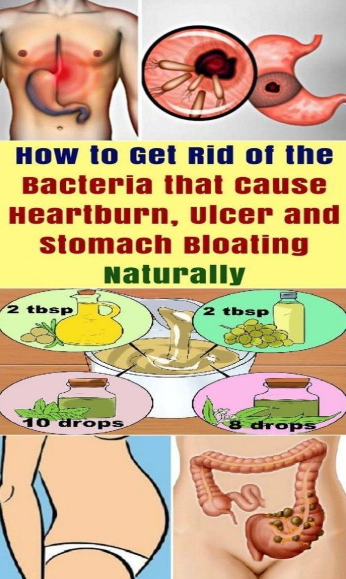 Get Rid Of The Bacteria In Your Stomach That Causes Ulcer ...