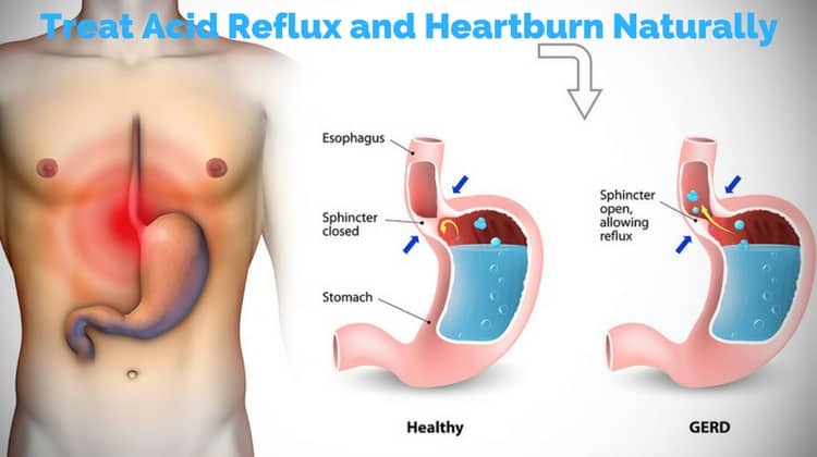 Home Remedies to Treat Acid Reflux and Heartburn Naturally