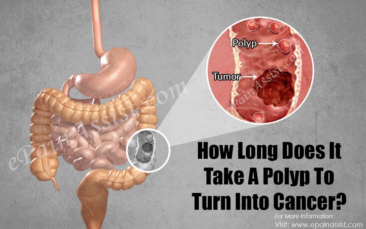 How Long Does It Take A Polyp To Turn Into Cancer?