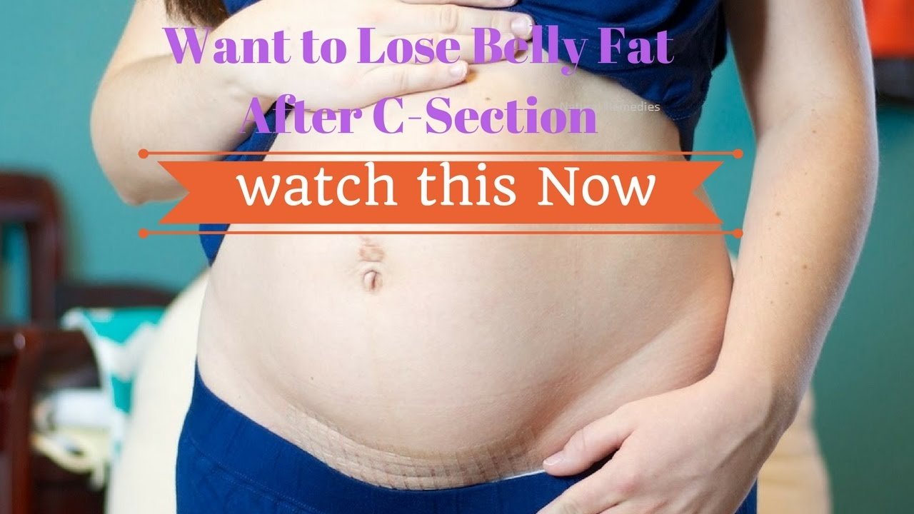 How to Lose Belly fat After C Section #NaturalRemedies ...
