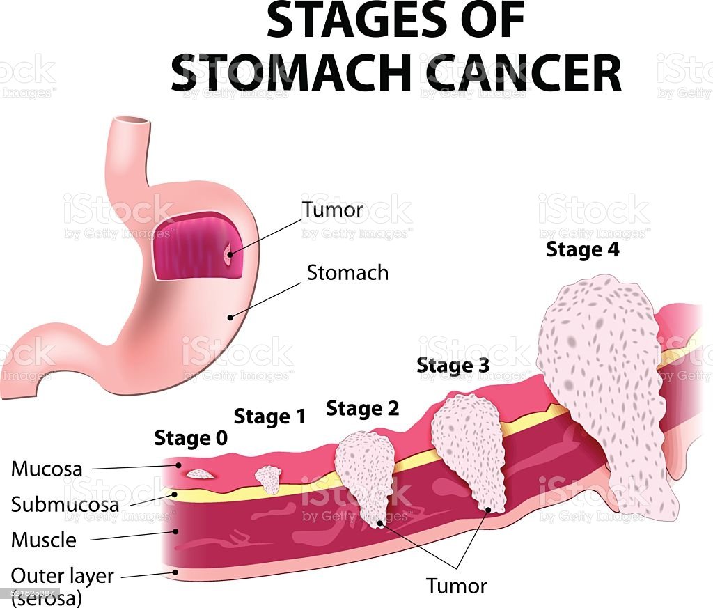 Staging Of Stomach Cancer Stock Illustration