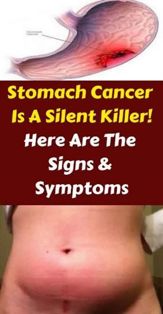 STOMACH CANCER: A SILENT KILLER, MOST COMMON SYMPTOMS " DON ...