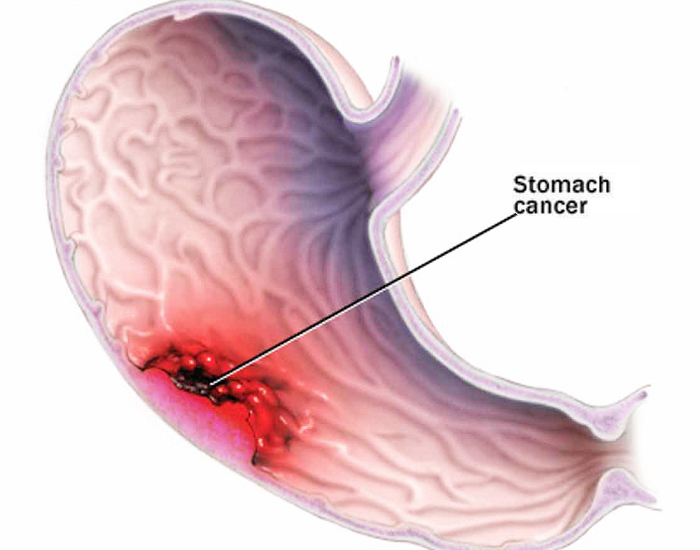 Stomach Cancer â Types, Causes, Diagnosis &  Treatment