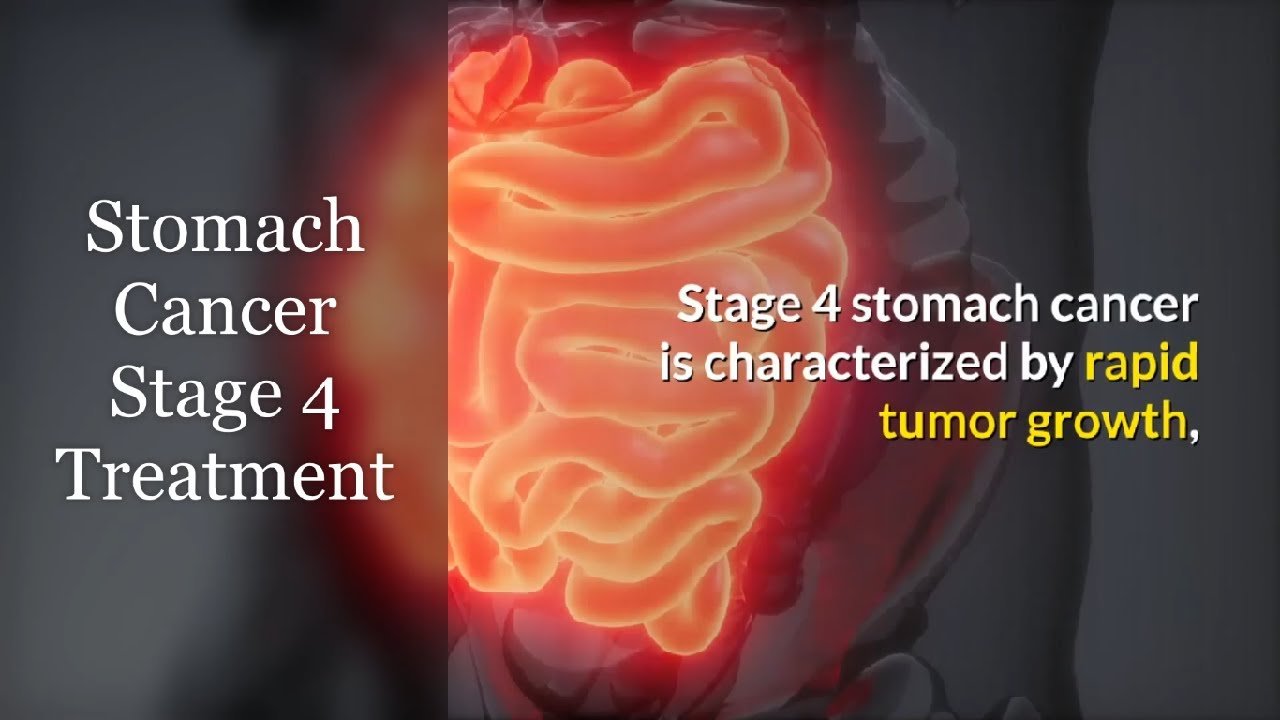 Stomach Cancer Stage 4 Treatment