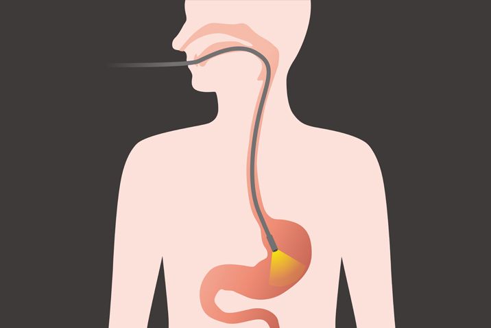 Stomach Gastric Cancer Facts
