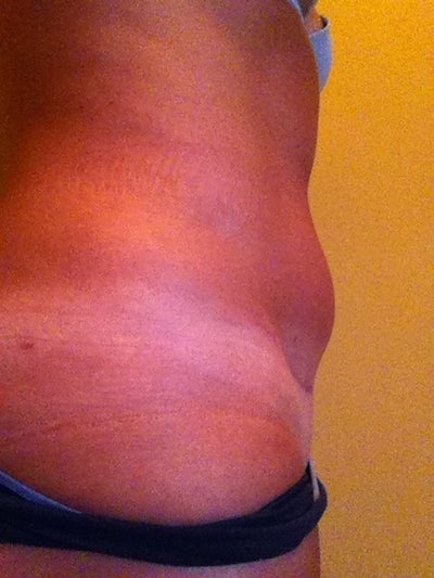 Tummy Tuck With Lipo 8 Months Ago and Area Below Belly ...