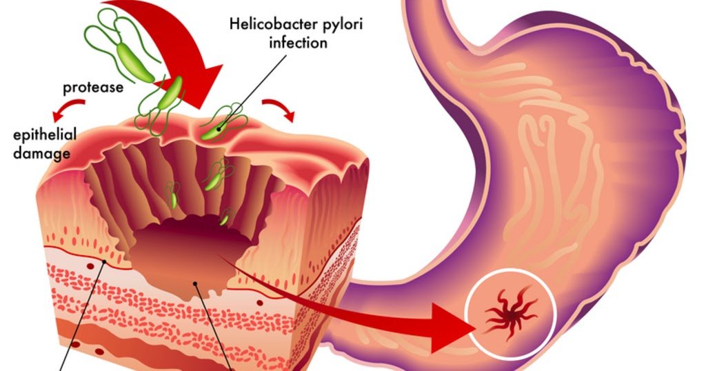What Causes Stomach Ulcers?