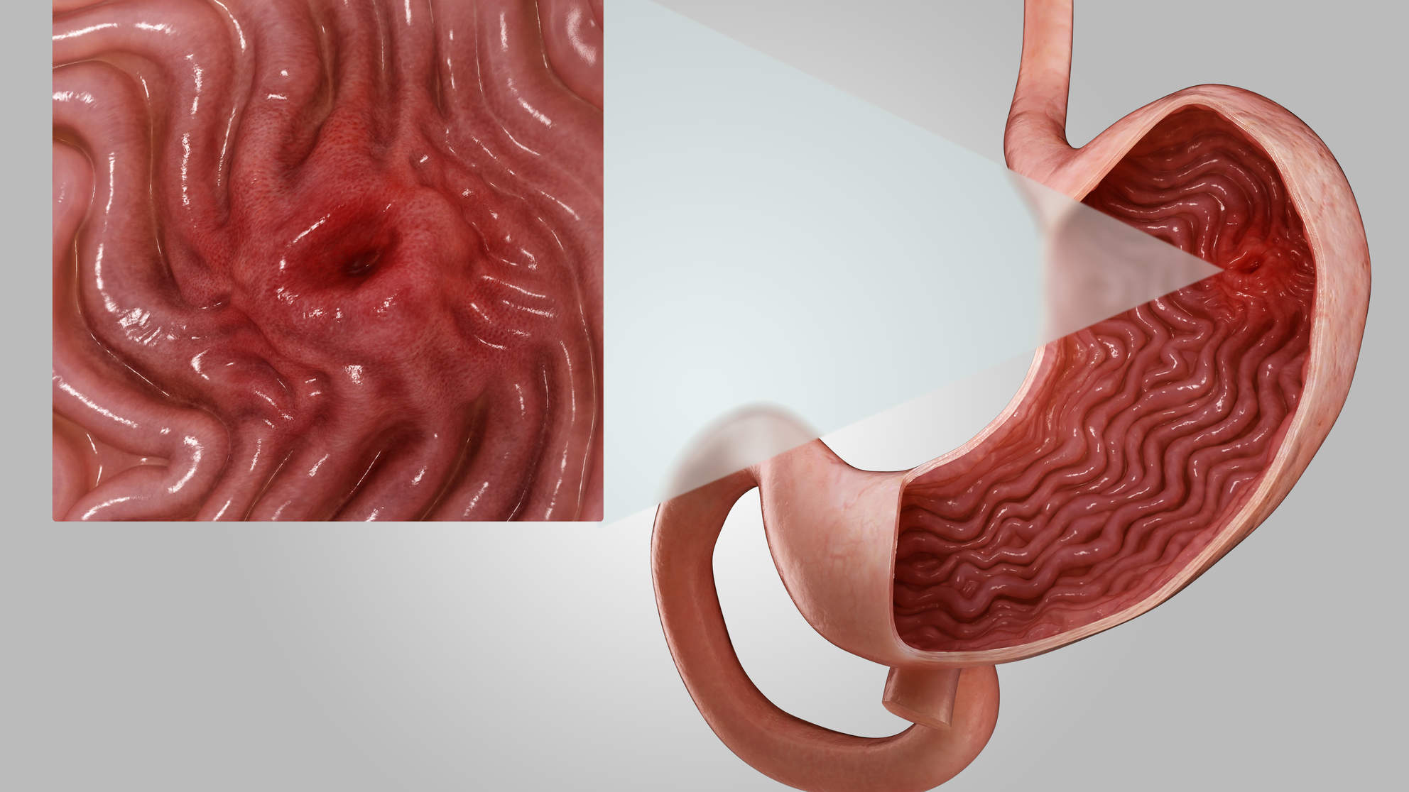 What Is a Stomach Ulcer? Gastroenterologists Explain ...