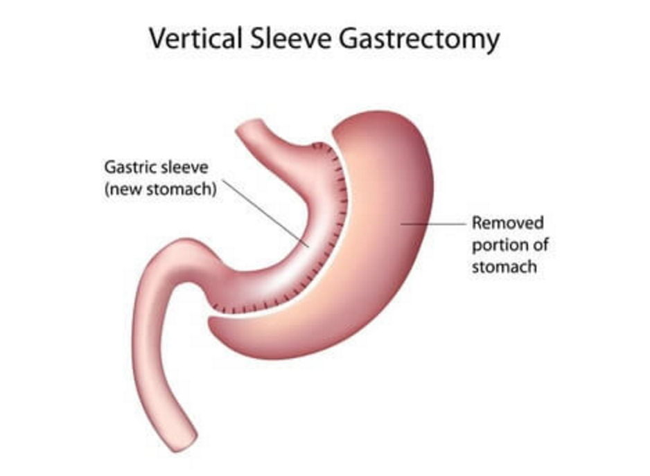 What is Bariatric Surgery and Does it Guarantee Sustained ...