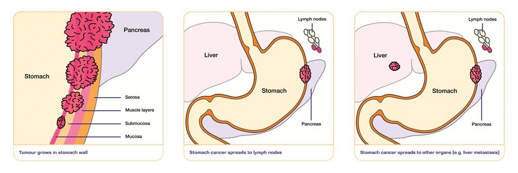 Where Does Stomach Cancer Spread To