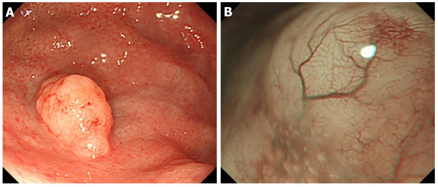 A case of gastric mucosa