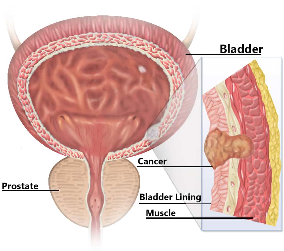 Abdominal cancer pain symptom Cancer symptoms abdominal ...