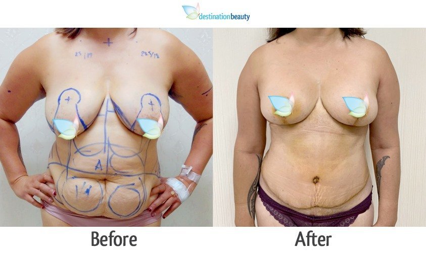 Breast Reduction, Extended Tummy Tuck, Arm Lift and Lipo ...