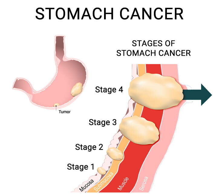 Gastric (Stomach) Cancer: Types, Symptoms, Diagnosis ...