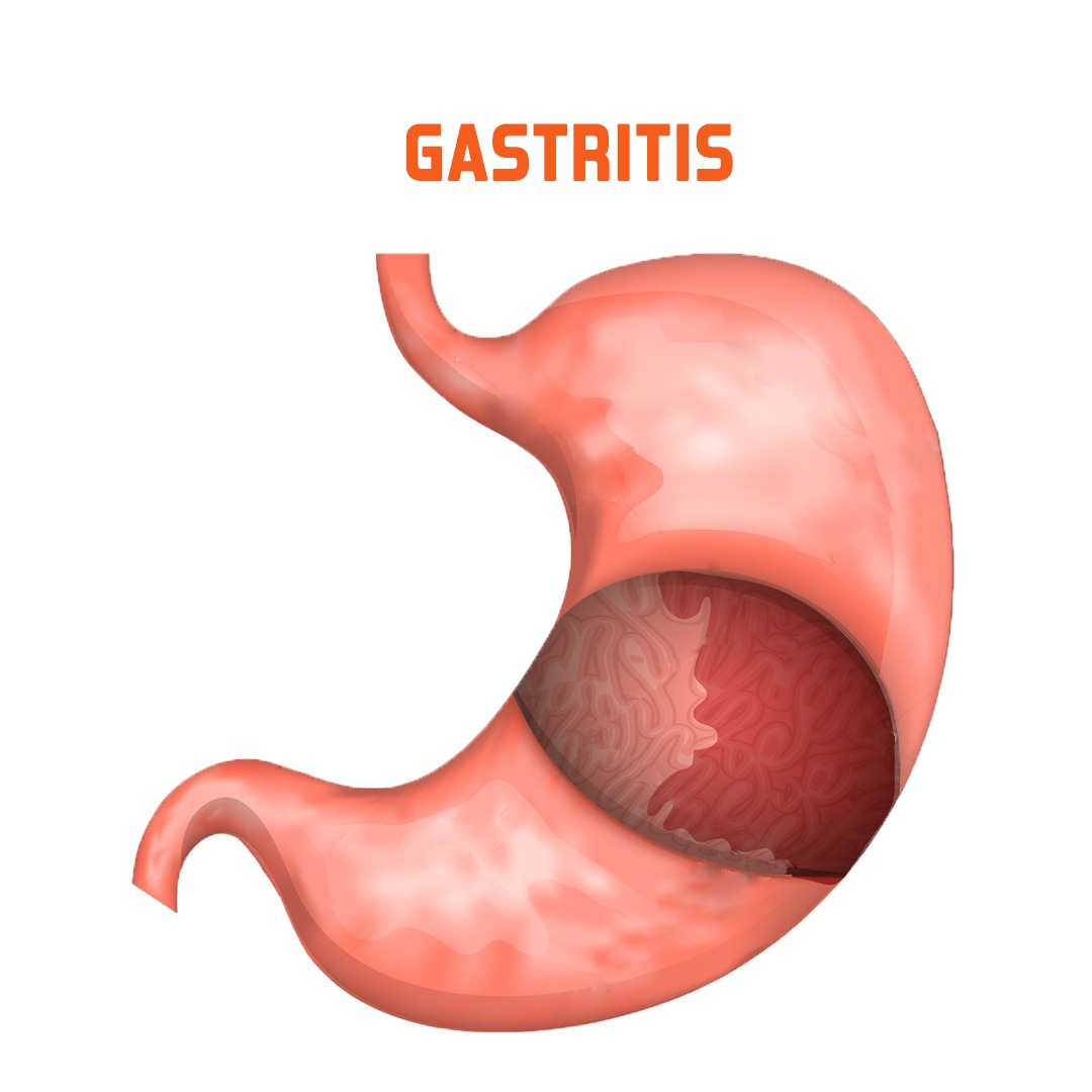 Gastro Symptoms