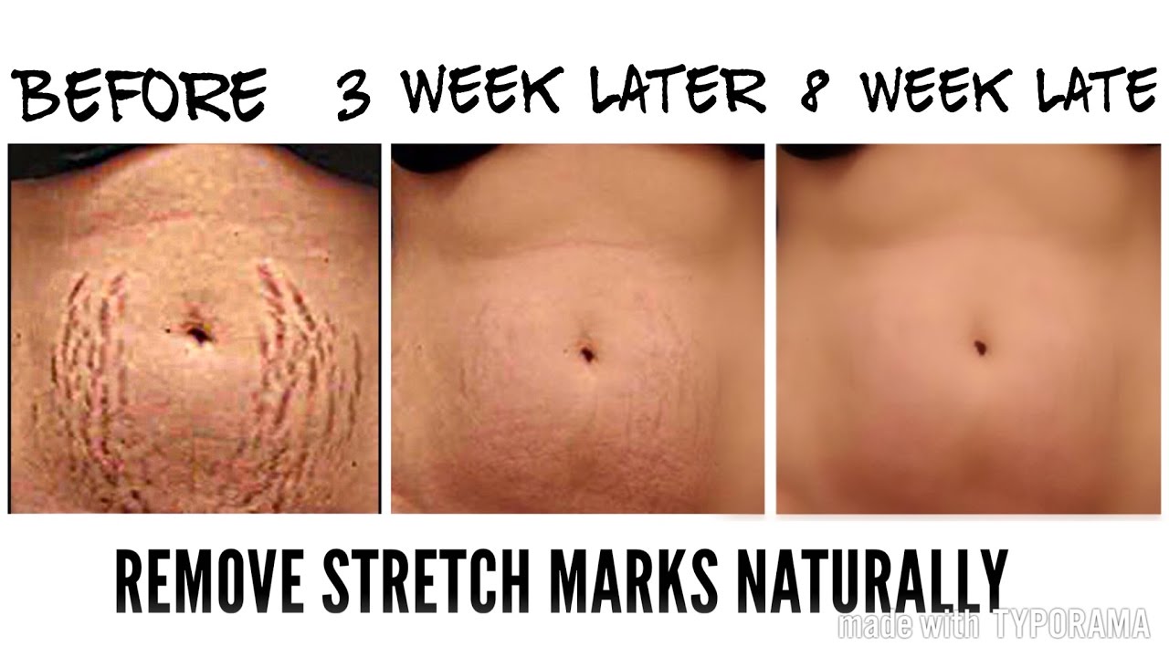 How do i get rid of my stretch marks fast MISHKANET.COM