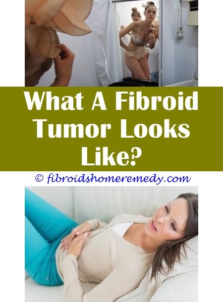 Pin op Fibroid Cyst On Ovary