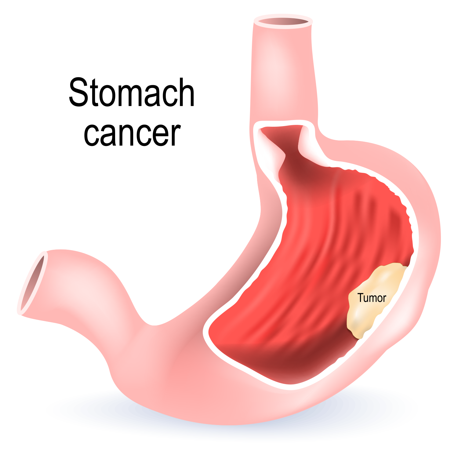 Protect Your Family from Stomach Cancer