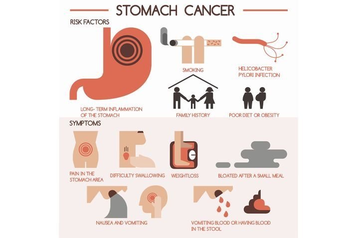 Symptoms Of Gastric Cancer