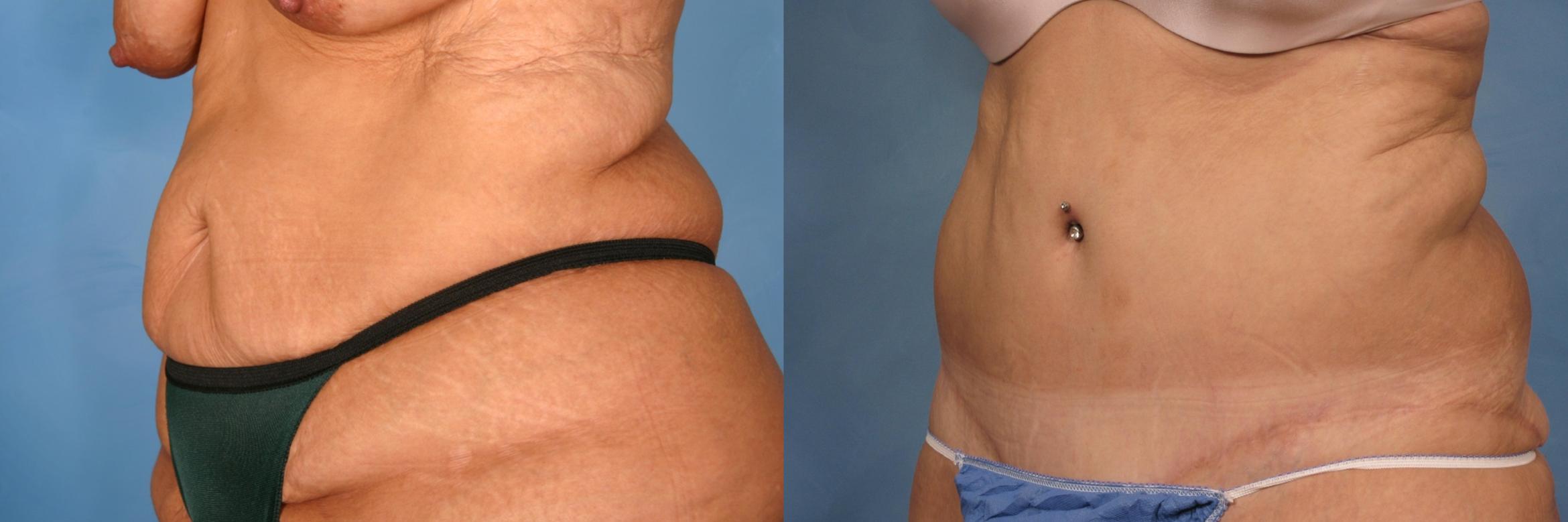Tummy Tuck Before &  After Photos Patient 112