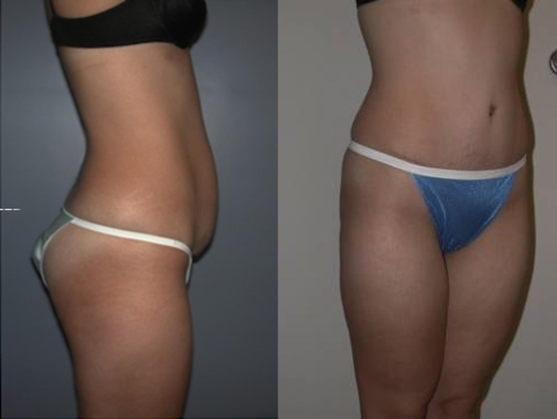 Tummy Tuck Before &  After Photos Patient 139
