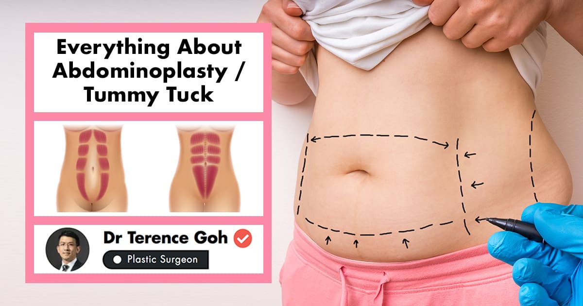 Tummy Tuck: Your Guide To Getting An Abdominoplasty In ...