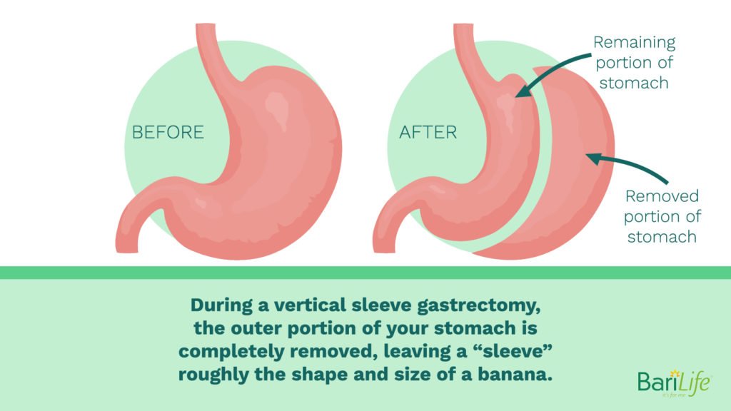 Can liquids stretch your stomach after gastric sleeve surgery?