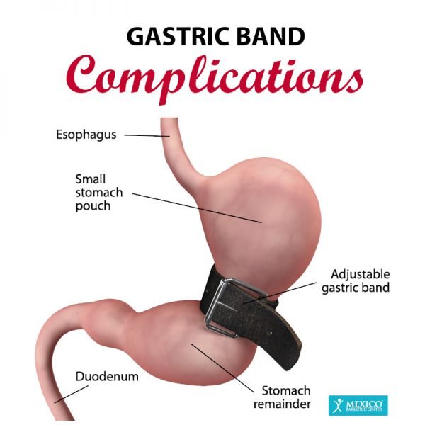 Gastric Banding (Lap