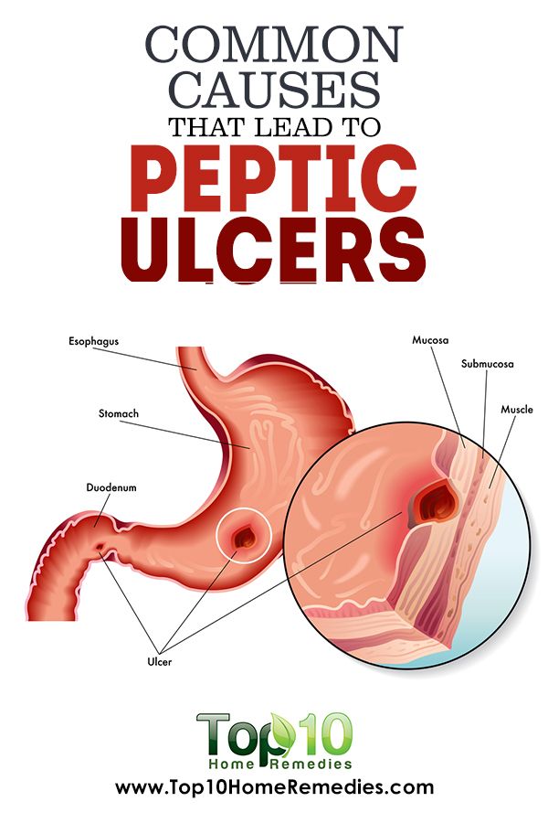 Hereâs everything that you must know about peptic ulcer ...