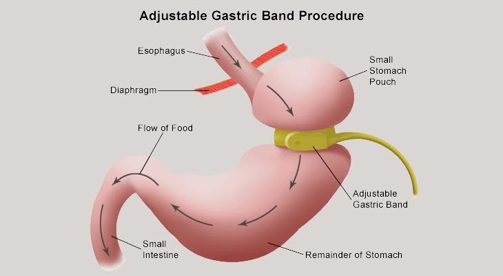 Medical Travel Management: Gastric Sleeve vs Gastric ...