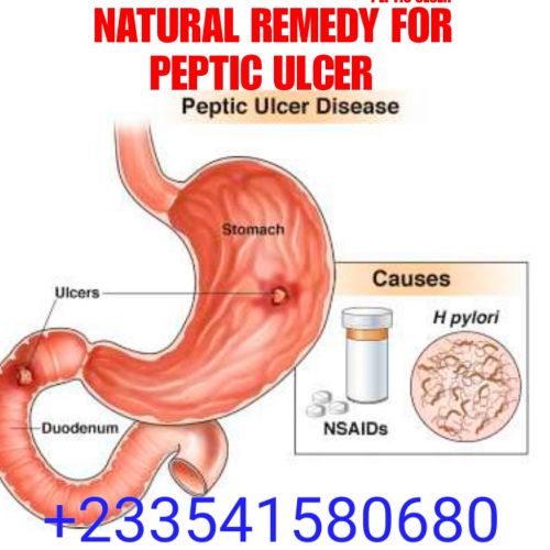 NATURAL TREATMENT FOR PEPTIC ULCER IN GH