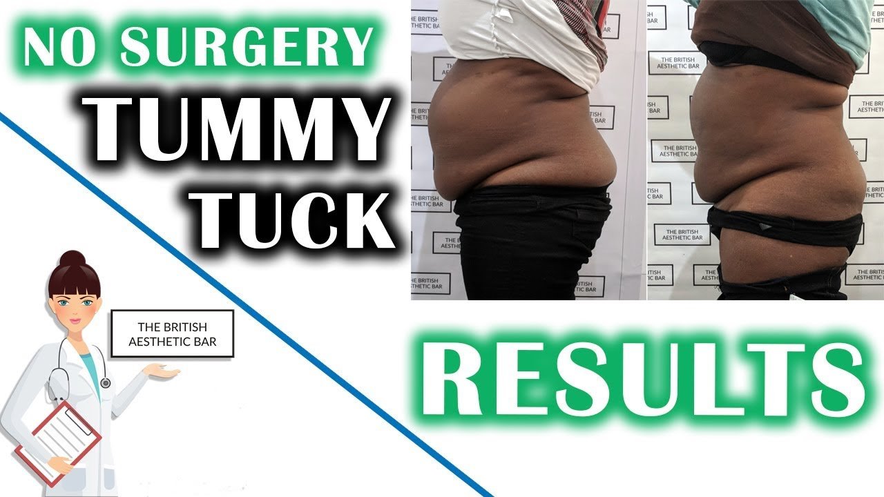 Reduce Belly Fat Without Surgery