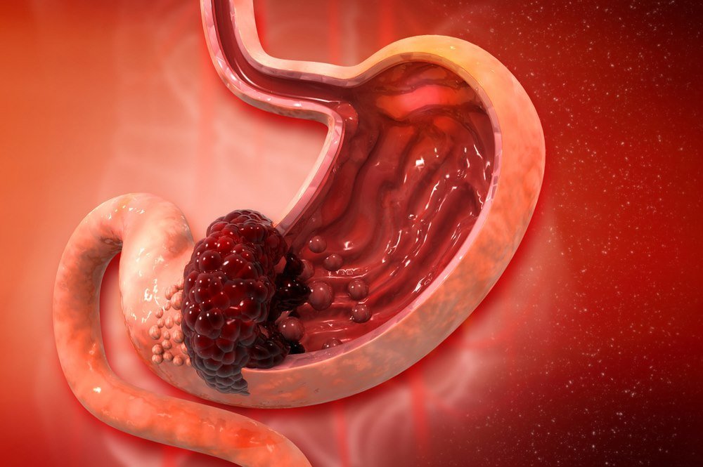 Stomach Cancer : Symptoms, Causes, Stages, Diagnosis ...