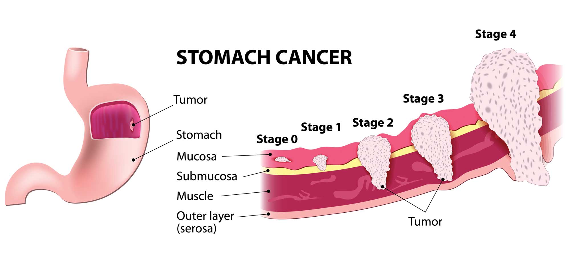 Stomach Cancer Treatment in Anchorage