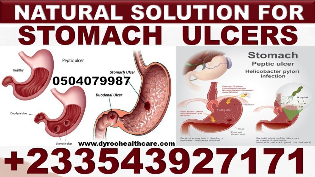 TREATMENT FOR PEPTIC ULCER IN GHANA