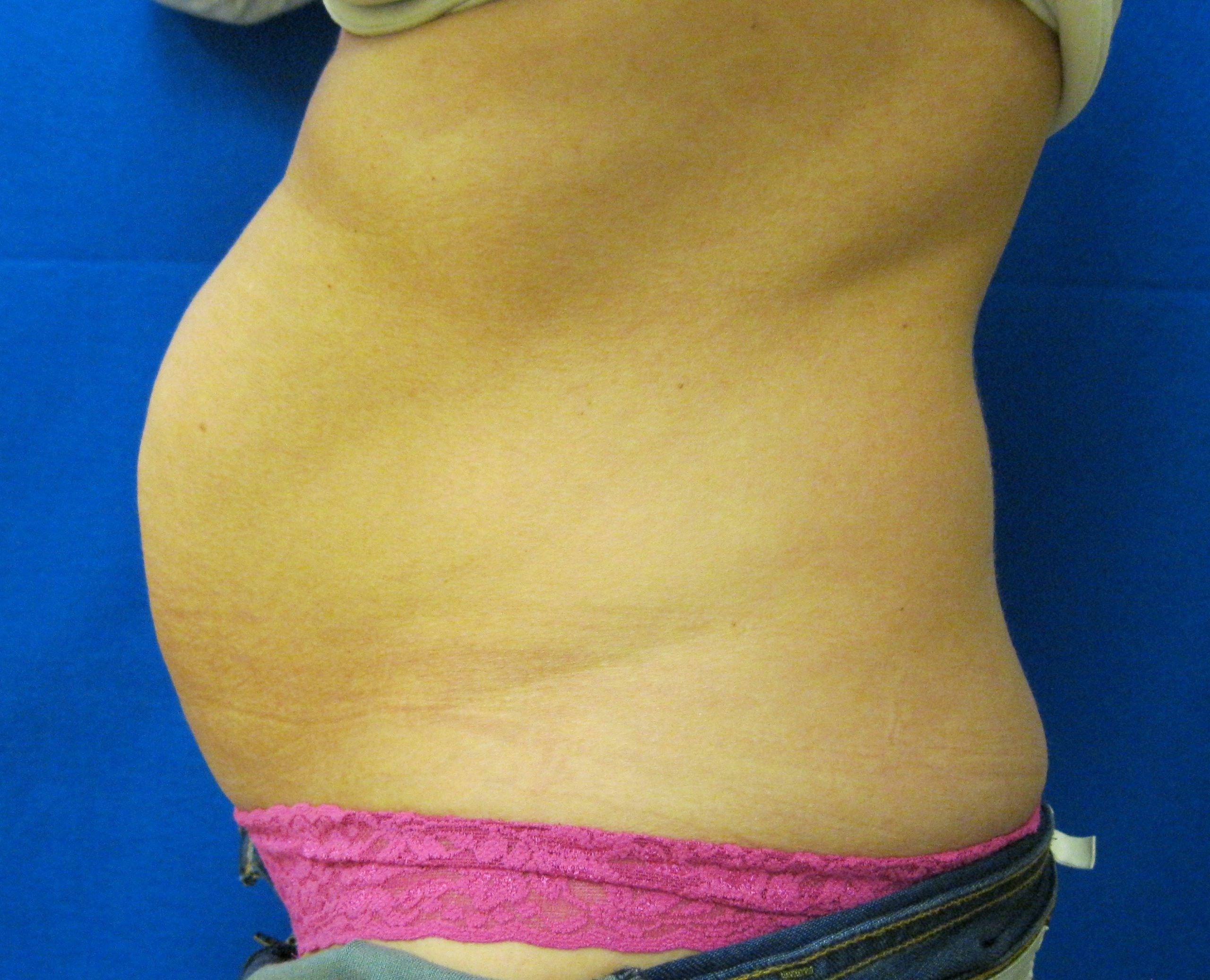 Tummy Tuck Liposuction Fairfield Bridgeport CT
