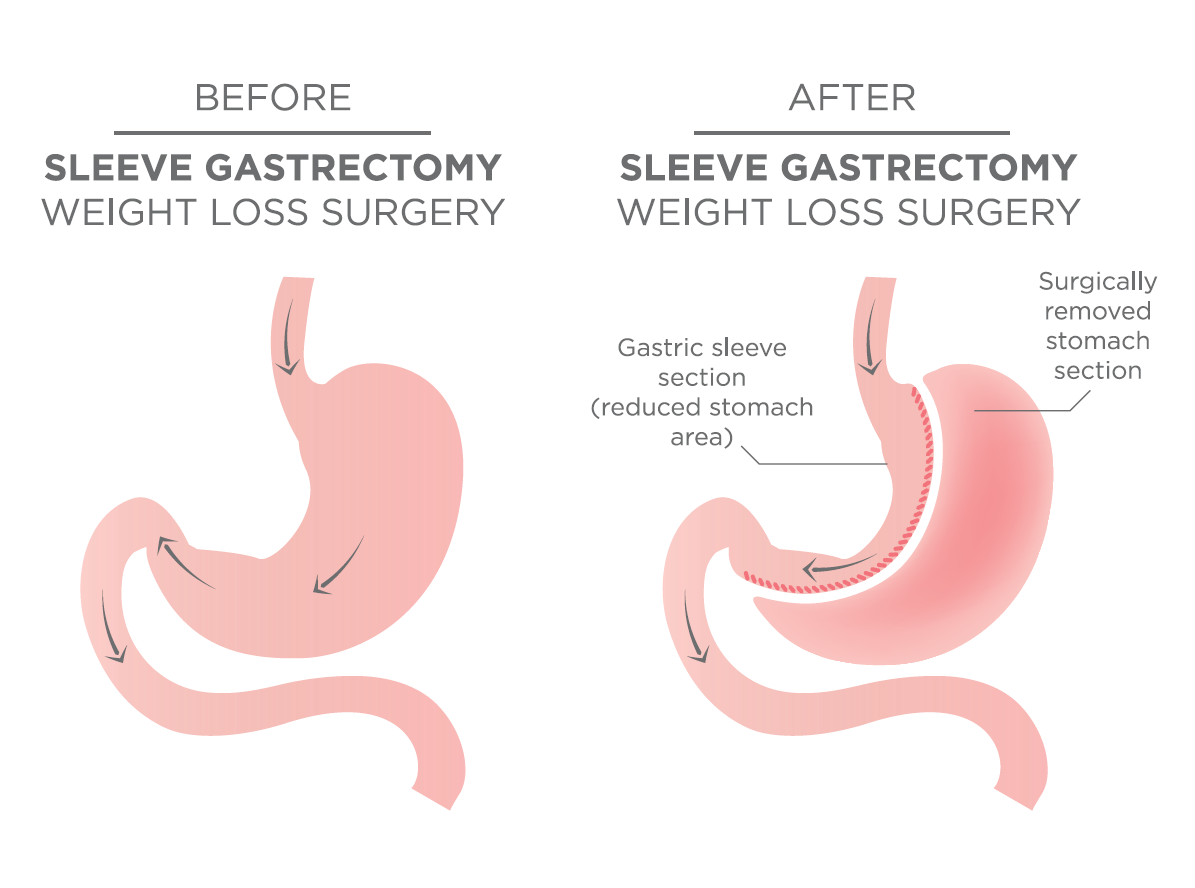 Vertical Sleeve Gastrectomy/Gastric Sleeve Surgery Gold Coast