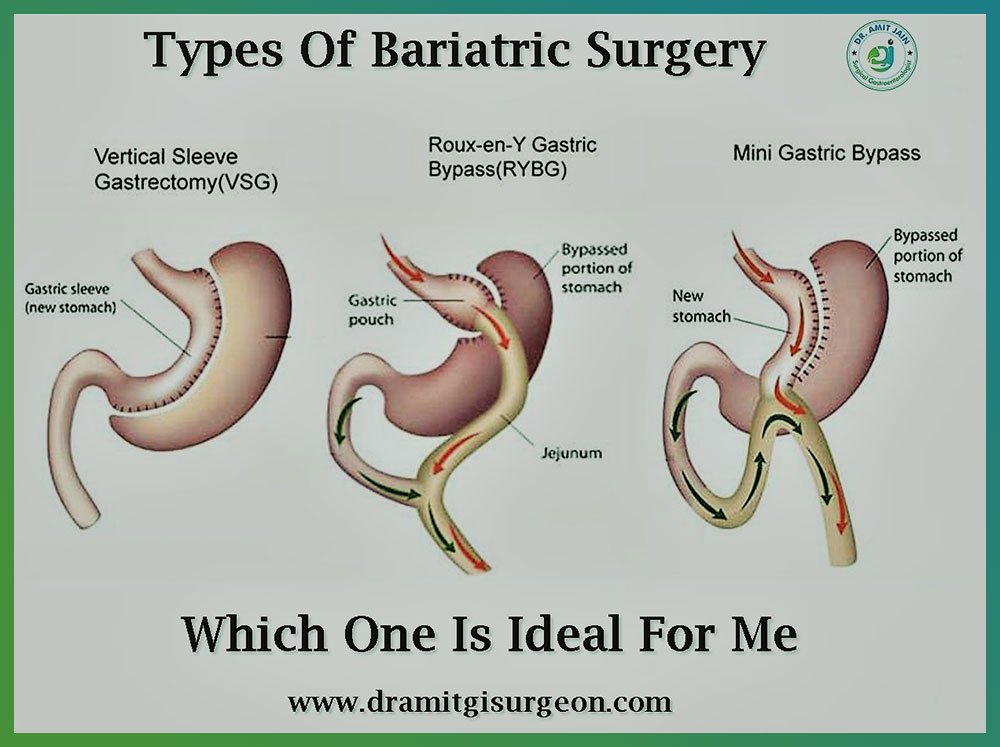 Best Bariatric Surgeon for By Pass or Sleeve Gastrectomy ...