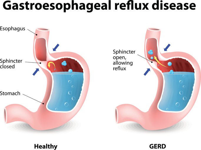 How To Get Rid of Acid Reflux... Naturally