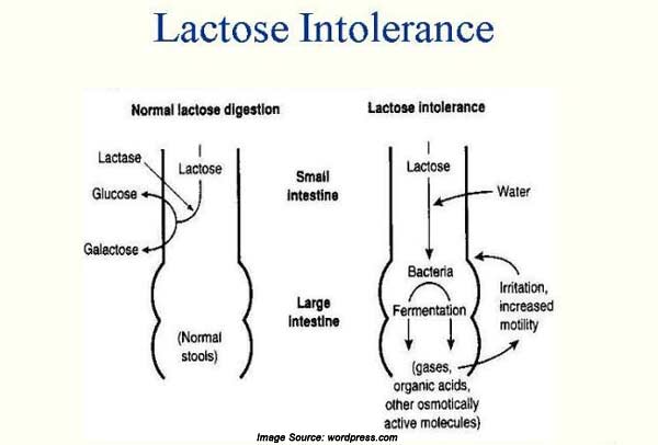 Lactose Intolerance: Types, Symptoms, Causes, Diagnosis ...